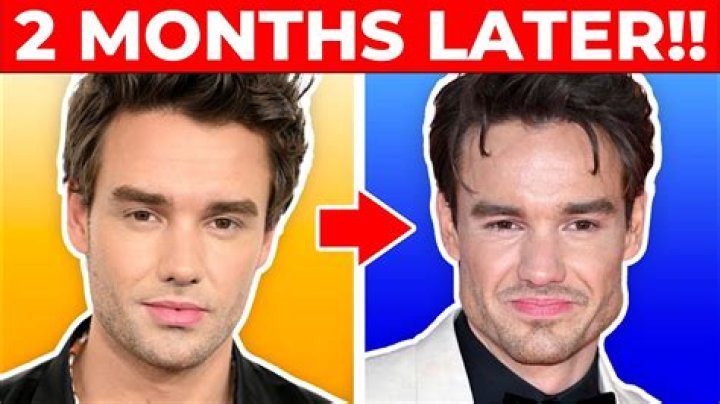 Liam Payne's Transformation: The Truth Behind His Plastic Surgery Rumors