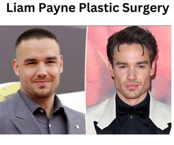 Liam Payne Surgery: A Journey Through Recovery