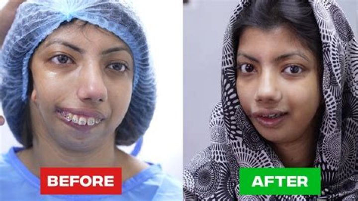 Transformations and Triumphs: Minitinah Before Surgery