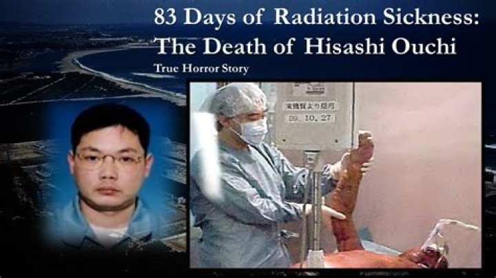 Understanding Hisashi Ouchi's Body: A Tragic Case of Radiation Exposure