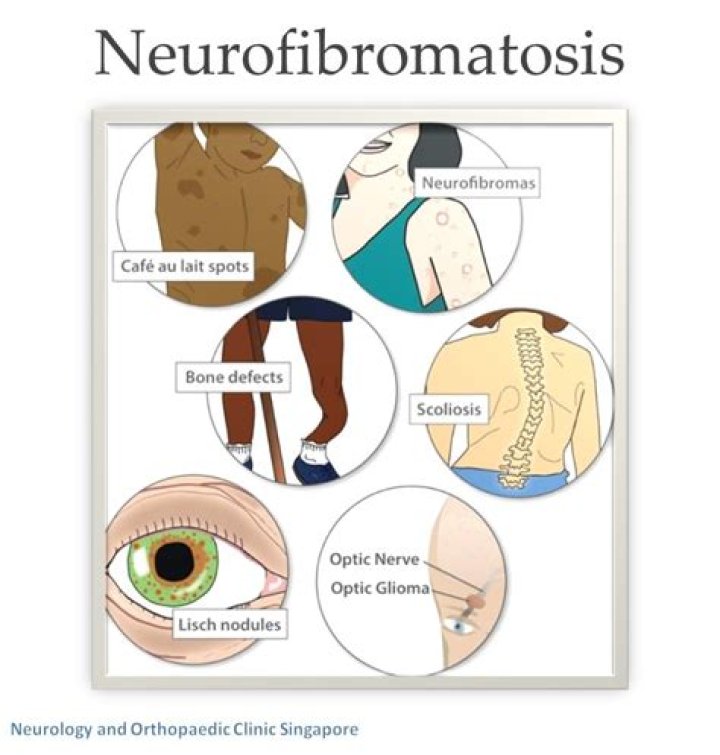 Understanding Neurofibromatosis Amare: Symptoms, Causes, Diagnosis, and Treatment